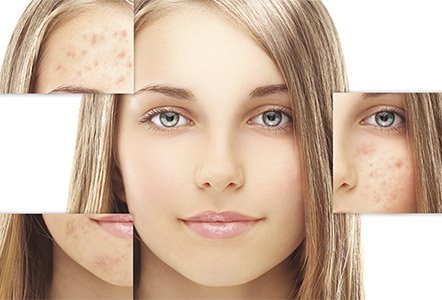 What to Avoid if You Are Getting Rid of Acne with Laser Treatment post thumbnail image