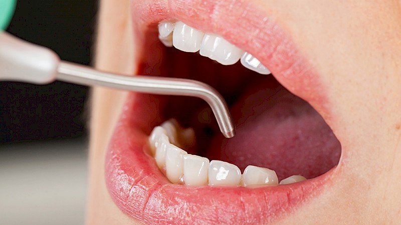 Clean interdental spaces (Zahnzwischenräumereinigen) are difficult, especially since they are small and inconspicuous spaces post thumbnail image