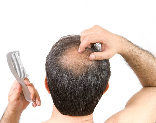 Informative post about getting a hair transplant surgery post thumbnail image