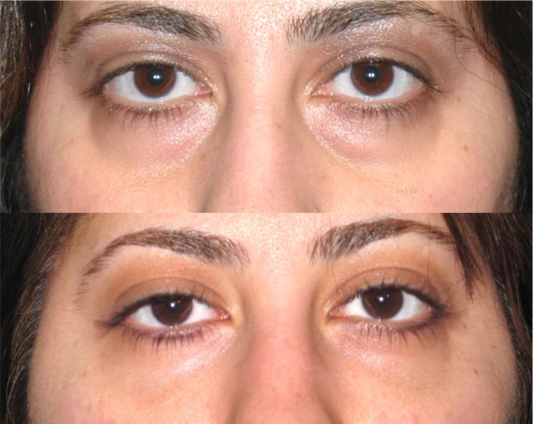 The eyelid surgery Santa Barbara eliminates droopy eyelids post thumbnail image